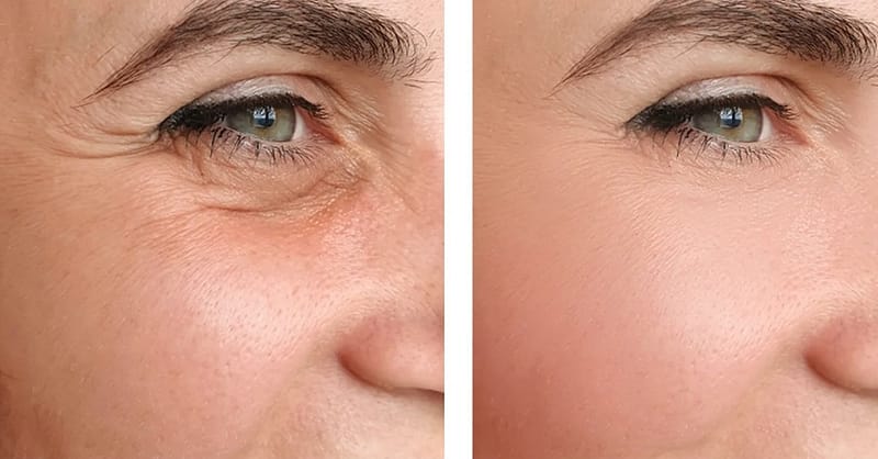 Choice Of Botox Injections National Deal - Image 2