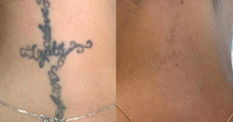 Three Sessions Of Laser Tattoo Removal: Small, Medium, Or Large Area Dubai - Image 3