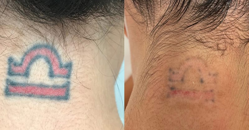 Three Sessions Of Laser Tattoo Removal: Small, Medium, Or Large Area Dubai - Image 5