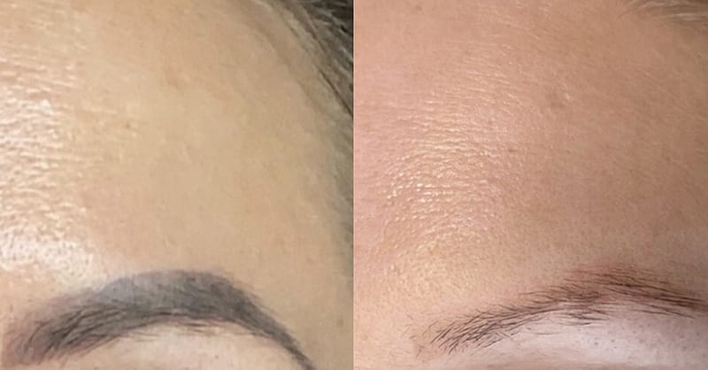 Three Sessions Of Laser Tattoo Removal: Small, Medium, Or Large Area Dubai - Image 6